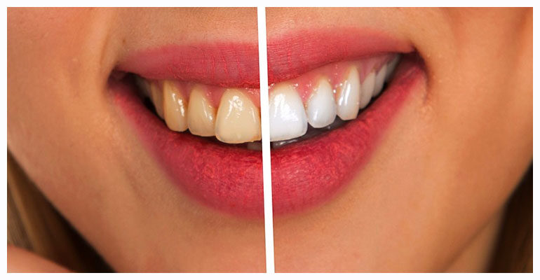 DiamondSmile LED Teeth Whitening Tray 6 DiamondSmile LED Teeth Whitening Tray
